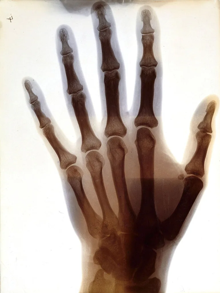 Una de las primeras radiografías de una mano, hecha con rayos X alrededor de 1896. Los huesos, más densos, bloquean más radiación y aparecen oscuros en la placa: así se ve desde fuera del cuerpo lo que hace el sistema óseo. Fotografía histórica, dominio público, vía rawpixel.