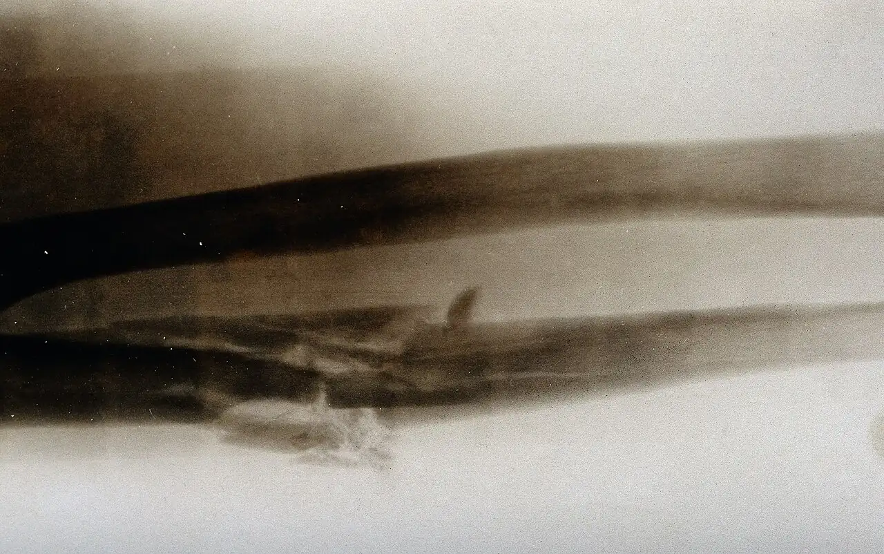 Una radiografía de un brazo con un hueso quebrado. I broke my arm: me quebré el brazo. Foto: Wellcome Collection, Wikimedia Commons, CC BY 4.0.